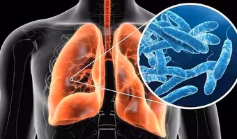 Legionnaires Disease | న్యూయార్క్లో విజృంభిస్తున్న లెజియోనెయర్స్ వ్యాధి.. అసలేంటిది.. ఎలా వ్యాపిస్తుంది..