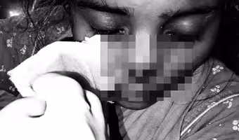 Man Bites Wife Nose | అరాచకం.. అదనపు కట్నం కోసం భార్య ముక్కు కొరికిన భర్త