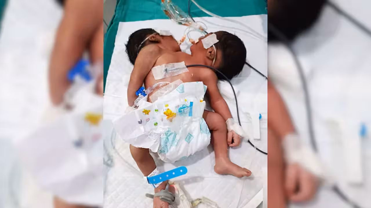 Conjoined Twins | ఒకే శరీరం.. రెండు తలలతో జన్మించిన బాలుడు.. శ్వాసకోశ సమస్యతో వారం రోజులు పోరాడి..