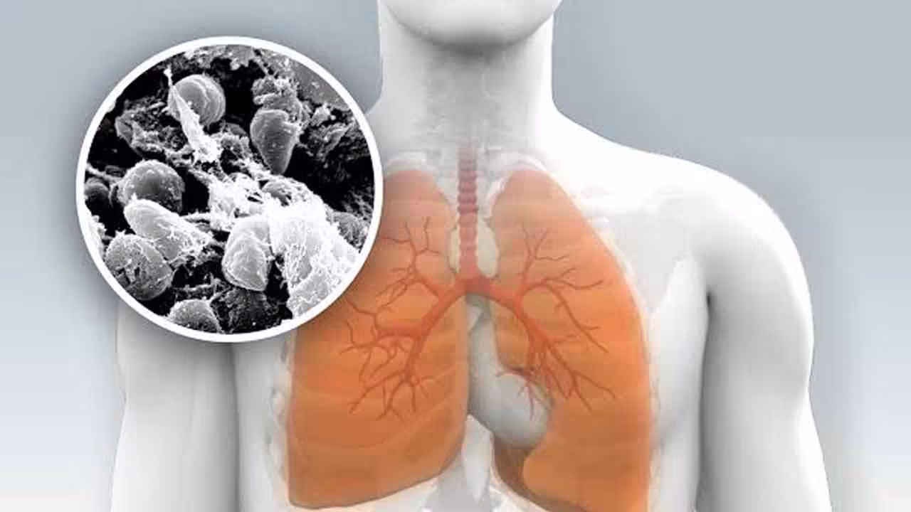 Pneumonic Plague | సైబీరియాలో న్యుమోనిక్ ప్లేగ్ కలకలం.. ఏంటిది.. ఎలా వ్యాపిస్తుంది, లక్షణాలు ఎలా ఉంటాయి..?